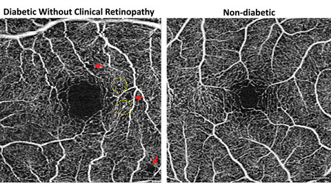 Foveal enlargement and perifoveal capillary remodeling detected with OCT-A in a diabetic eye without funduscopically visible diabetic retinopathy.