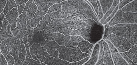 A superficial retina en face OCT-A montage of an eye with primary open angle glaucoma and severe thinning of the inferior NFL.