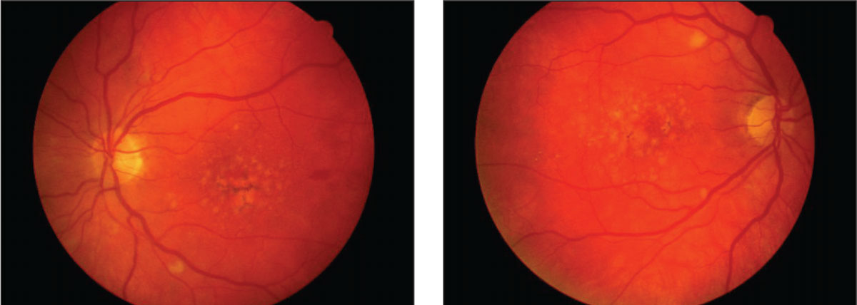 Macular degeneration, as demonstrated in these fundus images, is associated with the abuse of a number of illicit substances, including alcohol.