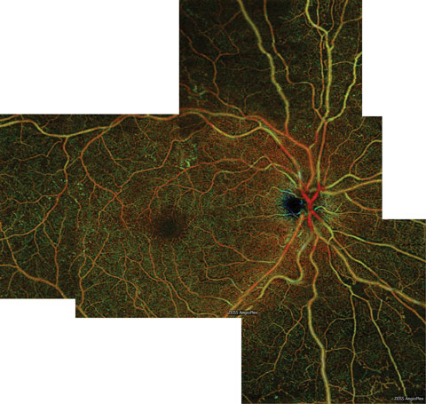 This color en face OCT-A montage of an eye with severe NPDR shows large areas of capillary nonperfusion inferior to the optic nerve, which extend into the inferior midperiphery.