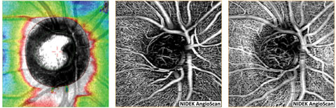 NFL and en face OCT angiograms of an eye with normal tension glaucoma shows the loss of NFL superior nasal with corresponding thinning of the radial peripapillary capillaries.