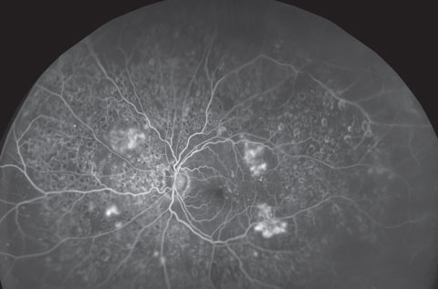 UWFI can provide expansive views of the retina and help document the progression of myriad conditions, such as diabetic retinopathy, seen here in its severe form. Photo: Optos