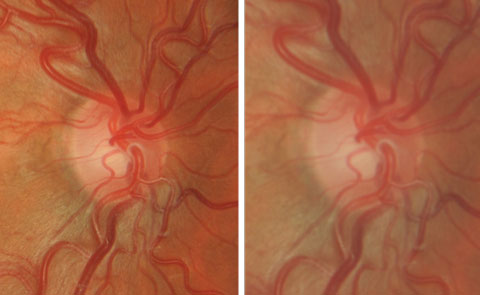 Increased magnification (right) results in a “hazier” view. 