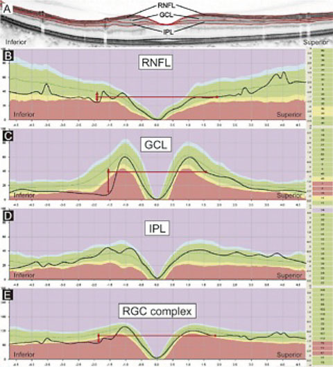 This image represents several indices that may be examined in an OCT printout—RNFL, GCL, IPL and the RGC complex (GCC)—compared with a relative database.