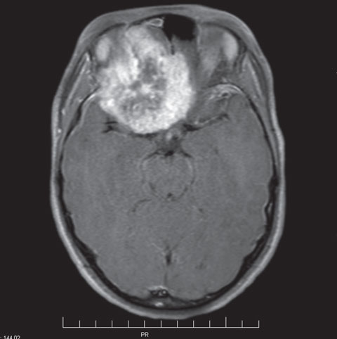 The patient’s emergency MRI reveals the tumor—a few years too late.