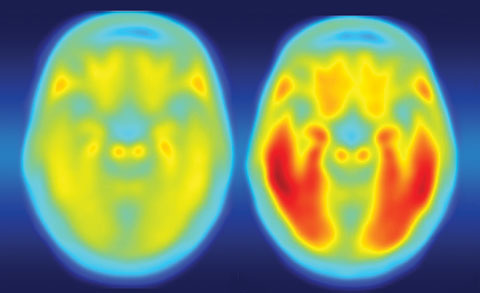 Defective tau protein, as seen on the right positron emission tomography image, accumulates in the brains of patients with Alzheimer’s disease, Parkinson’s disease and CTE. 