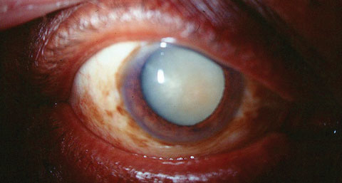 Removal of a dense cataract, such as the one seen here, can require the patient to commit to a drop schedule that may be confusing. Luckily, several options can help eliminate, reduce or assist with the need for post-op drops.
