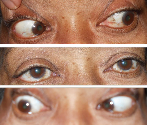 Note the normal movement of the eyes gazing to the left and straight in the top two photos. The bottom photo shows the patient’s eyes in right gaze and her inability to fully abduct the right eye.