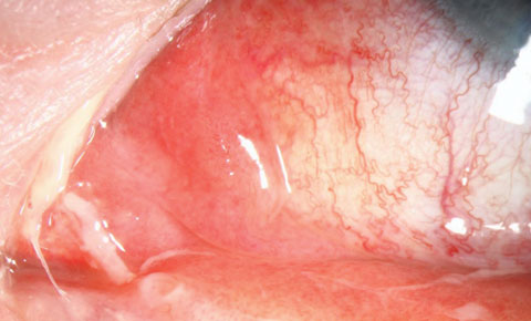 Fig. 1. This patient presented with dacryocystitis. Photo: Christine Sindt, OD