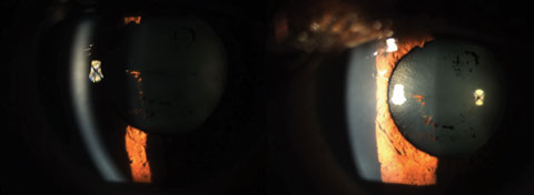 This photo shows dramatic improvement over one week of the anterior uveitis (4+cell/4+flare) with Durezol six times a day and cyclopentolate BID. Photo: Sulman Hans, OD
