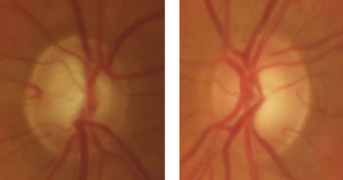 This 69-year-old white male has no family history of glaucoma. His initial IOP was 42mm Hg in the right eye and 36mm Hg in the left. With brimonidine BID, dorzolamide BID and latanoprost QHS, his IOP is now 15mm Hg in both eyes.