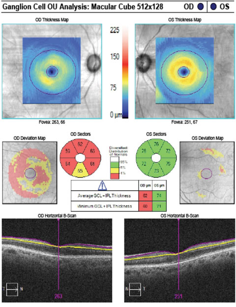 The patient’s GCA correlates with rim thinning in the right eye and a normal left eye.