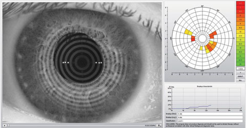 This Keratograph 5M (Oculus) image shows an assessment of a patient’s noninvasive tear break-up time. Photo: Dan Fuller, OD