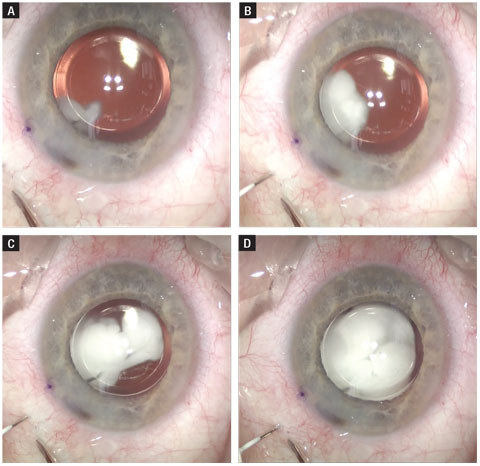 Here, this time lapse shows an intravitreal injection of triamcinolone and moxifloxacin. The needle is routed posterior to the IOL and has a similar final destination to that of an anti-VEGF injection.