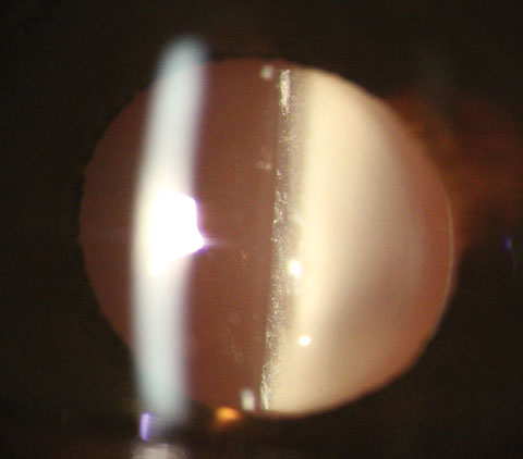 Presentation one day after dropless cataract surgery using Tri-Moxi. Note the white “snowglobe” appearance in the anterior vitreous common after dropless surgery.
