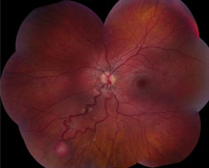 Peripheral retinal capillary hemangioma is located inferior-nasally with dilated, tortuous vasculature in Von Hippel-Lindau disease.