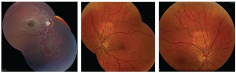 At left, an engorged artery and vein in an arterial-venous malformation extends from the optic disc to the inferior peripheral retina in a patient with Wyburn-Mason syndrome. At middle and right are choroidal hemangiomas.