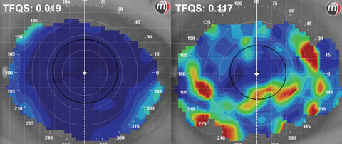 Fig. 1. Tear film quality scores (TFQS) as measured by placido disc topography. A low score (left) indicates better tear film quality than a higher score (right).
