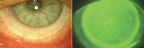 Fig. 3. At left, a scleral lens allows full coverage of the cornea and variable conjunctival coverage with a 100µm to 200µm tear layer between the lens and the corneal surface. At right, the same eye with NaFl instilled to visualize the tear layer.