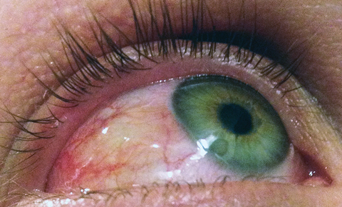 Ocular allergy often includes chemosis, conjunctival injection and eyelid edema. 