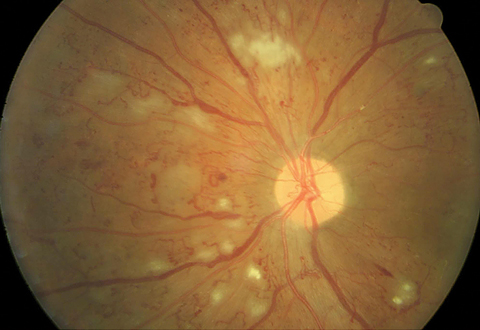 Non-high risk PDR is evidenced by a small amount of neovascularization on the optic nerve. Large amounts of retinal hemorrhages, cotton wool spots and intraretinal microvascular abnormalities (IRMA) are present. Photo: Erik Hanson, MD