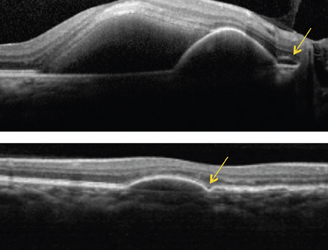 Above, this SD-OCT shows a PCV patient. Note the dome-shaped elevation of RPE with an adjacent double layer sign (see arrow) and a serous retinal detachment. Below, this SD-OCT shows a different patient with PCV demonstrating a PED with a bola sign (see arrow).