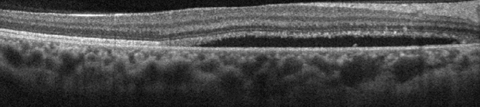 This SD-OCT shows a CSC patient demonstrating relatively thickened choroid (pachychoroid) with dilation of large choroidal vessels (pachyvessels) and relative absence of choriocapillaris and Sattler’s layer in the area underlying the subretinal fluid.