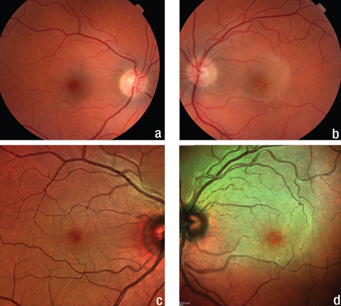 Fig. 1. The fundus and multicolor images of the patient’s right eye (a, c) show no abnormalities, but the same images of her left eye (b, d) show a yellow, plaque-like lesion extending from the optic nerve into the superior macula.