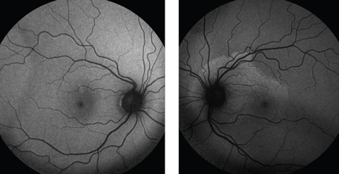 Fig. 3. Fundus autofluorescence demonstrates a normal right fundus, but the left  shows mottled hyperfluorescence around the optic nerve and superior macula, indicating lipofuscin accumulation in the RPE.