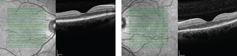 Fig. 2. While our patient’s right macula appeared  normal on OCT, her left eye demonstrated a disruption of the PIL.