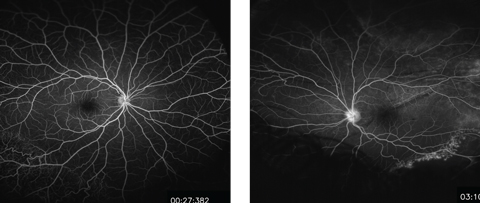 Figs. 3 and 4. These midphase FA images show the patient’s right (at left) and left eyes. Do they reveal any pathology?