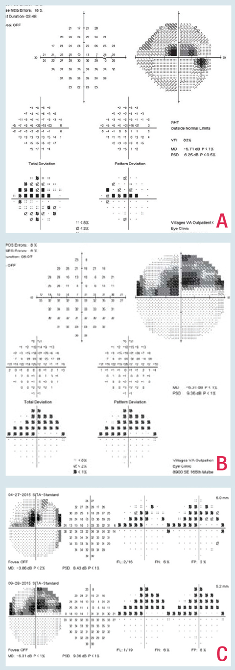 This patient presented with severe inferior temporal glaucomatous structural damage and has a corresponding superior central and paracentral 24-2 VF defect (A). Central 10-2 testing reveals the extent of this defect and better highlights the possible progression that likely would have been underestimated or missed on 24-2 testing alone (B and C).