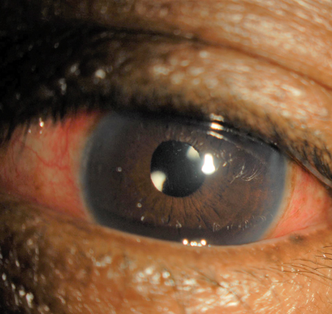 This one-day postoperative cataract surgery patient displays redness indicating inflammation, similar to the inflammation laser procedure patients face.