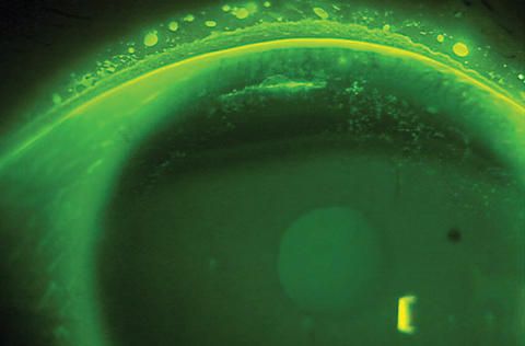 Fig. 3. Superior epithelial arcuate lesions, as seen here, can result mechanical friction of the lens on the cornea. Mostly seen in those who wear high-modulus silicone hydrogel contact lenses.
