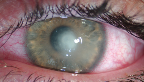 This patient was diagnosed with Acanthamoeba keratitis from wearing soft contact lenses in a hot tub. Photo: Jeffrey Sonsino, OD