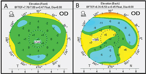 Fig. 3. Here is an example of an elevation map from the Pentacam.