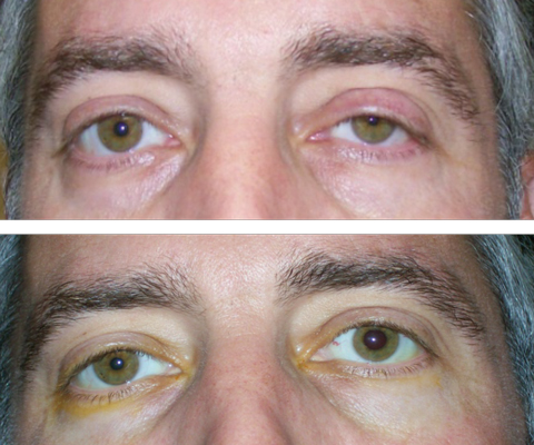 At top, this patient presented with suspected left Horner’s syndrome, pre-apraclonidine testing. At bottom, post-apraclonidine testing led to reversal, confirming the diagnosis.