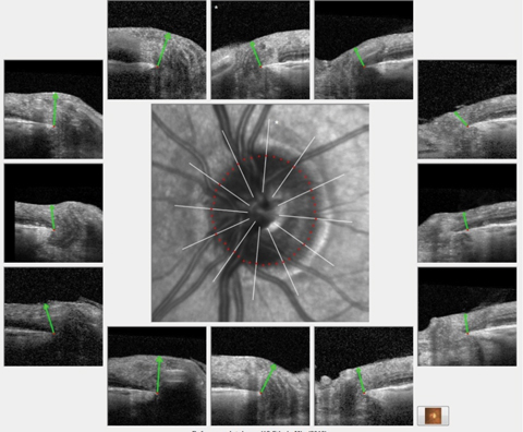 Analysis of the BMO profile of the left eye demonstrated a robust ganglion cell thickness throughout the entire left optic nerve similar in appearance to these HRT 3 scans of the same eye.