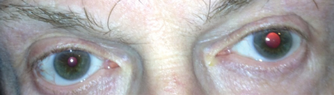 Fig. 1. The pupils of both eyes in bright light measuring 3mm and 4.5mm in the right and left eyes, respectively.
