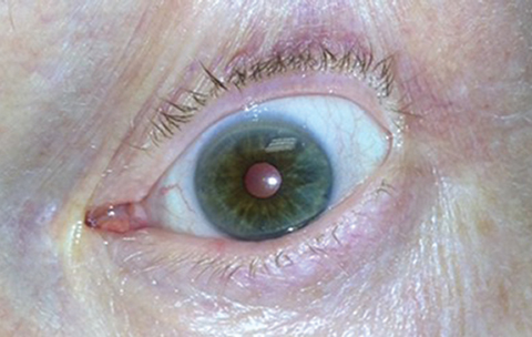 Fig. 2. In the same patient, we observed constriction of the left pupil 30 minutes after instilling 0.125% pilocarpine.