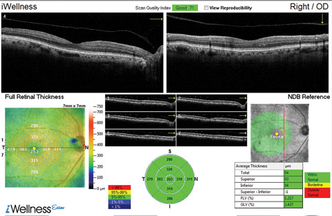 This OCT screening shows a patient who displayed no macular pathology but for a detached vitreous face. The macular exam showed no visible drusen. However, this patient did have early functional signs of AMD when we tested dark adaptation.