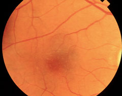 This patient shows signs of early AMD associated with drusen and areas of RPE disruption. This patient is already at risk for vision loss. With dark adaptation, ODs may be able to begin management of AMD before this clinically evident stage is even reached, in the hopes of preventing progression to the advanced stages of AMD.