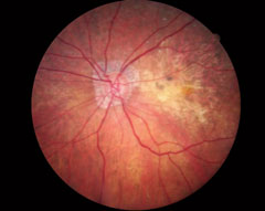 With dark adaptation, ODs may be able to begin management of AMD in the hopes of preventing progression to the advanced stages of AMD, as seen here. 