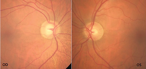 Fig. 1. The patient’s fundus photos show inferior temporal rim thinning with vessel bayoneting within the optic nerve OD. 