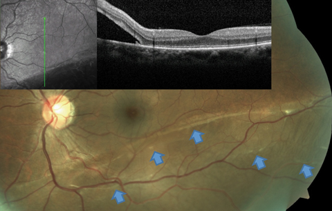 Fig. 3. This RRD patient’s OCT image, layered over a fundus photograph, shows partial involvement of the macula, even though the patient is totally asymptomatic from this slowly progressive inferior RD. Blue arrows point to a number of subretinal bands and partial demarcation lines, a testament to the chronicity of the condition.