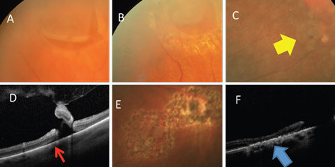 Fig. 5. (A) Horseshoe retinal tear is well bordered by laser (B). (C) Retinal breaks (yellow arrow) with (D) associated subretinal fluid (red arrow) well bordered by (E) laser. (F) Alteration of the RPE resulting in a watertight tissue (blue arrow).