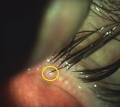 Intraductal meibomian gland probing, a manual procedure to open the meibomian orifices, can be considered in ocular rosacea patients with MGD.  