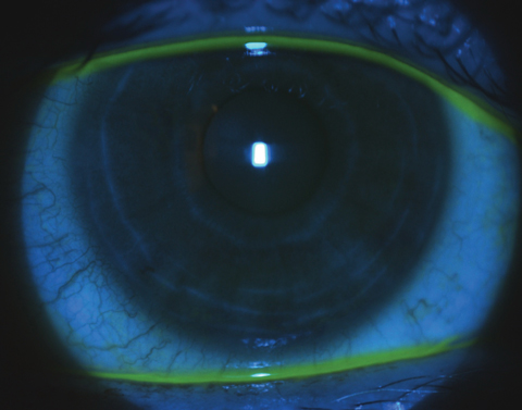 Reduced sodium fluorescein corneal staining of the same patient three weeks post-scleral lens wear.