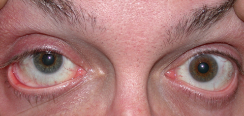 Patients with heterochromia, as seen here, have some procedural options, but with varying degrees of safety. Photo: Aaron Bronner, OD​