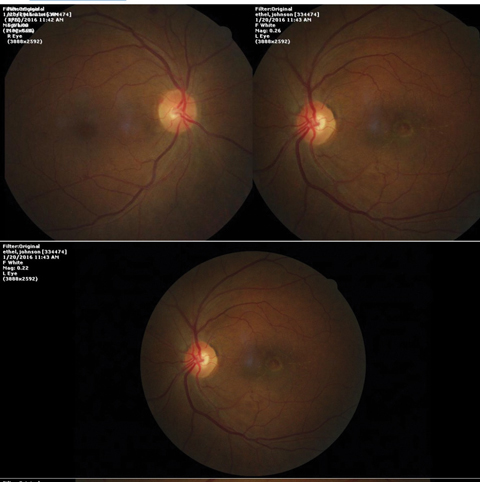 These fundus images show a 68-year-old female patient who presented with trouble reading.
